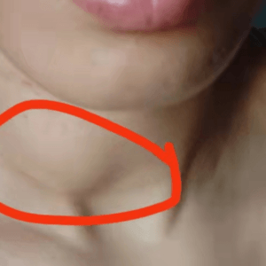 Thyroid tumor-before.