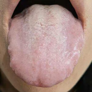 tongue diagnosis